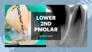 Endodontic Retreatment lower 2nd premolar Reciproc Blue [upl. by Iolande]