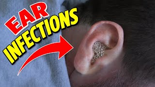 Ear infections the 2 main types [upl. by Messing]