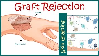 Graft rejection  Immunological basis of graft rejection [upl. by Sinned]