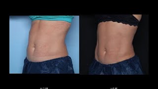 Diastasis Recti treated with Emsculpt [upl. by Sej]