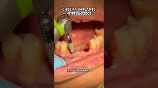 Dental Implants Surgery procedure front teeth extraction procedure cost of dental implants in india [upl. by Aileno]