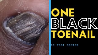 One Black Toenail Fungal Toenail Infection or Not [upl. by Seuqirdor]