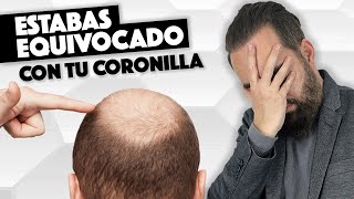 Estabas equivocado sobre la Evolución de la coronilla de tu trasplante capilar [upl. by Egrog]