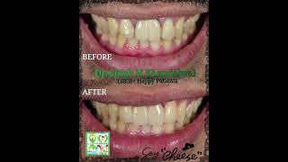 Before After Zirconia Crowns for Smile Designing Front Upper Teeth [upl. by Harriette546]