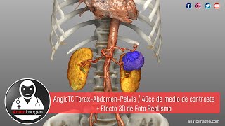 Angio Tomografía de Tórax Abdomen y Pelvis  Efecto Foto Realista [upl. by Bond]