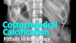 Costochondral Calcification  Pitfalls in Radiology radiology [upl. by Osnerol]