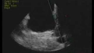 intracardiac echocardiography ICE [upl. by Aniara]