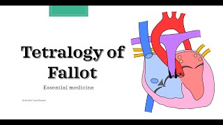 Tetralogy of Fallot Essential medicine [upl. by Boehike137]