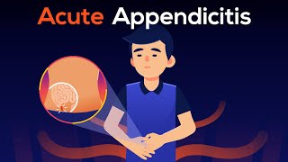 What is Appendicitis A real case of Burst Appendix [upl. by Emmeline]