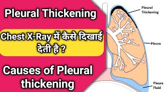 pleural thickening of the lungs  pleural thickening chest x ray [upl. by Natsud344]