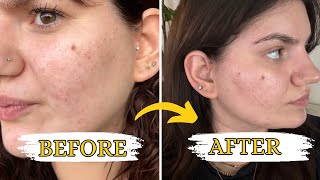 My acne scars after Laser Genesis Treatments [upl. by Girand]