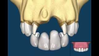 Bridge VS Implant [upl. by Smoht]