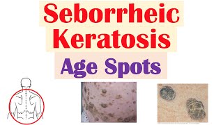 Seborrheic Keratosis “Age Spots”  Risk Factors Causes Skin Lesions Diagnosis Treatment [upl. by Waxman]