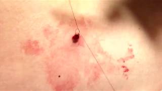 2mm PUNCH BIOPSY of atypical appearing mole nevus ABCDE of Melanoma [upl. by Imojean886]