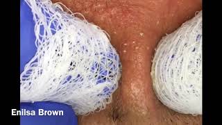 Filament Ingrown Hair and Blackheads Short and Sweet Video of Daryl [upl. by Alva902]