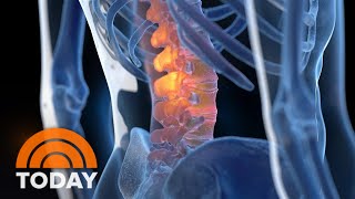 New therapy aims to cure back pain without drugs surgery [upl. by Ahsitauq]