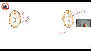 neuronalmigrationdefect porencephaly schizencephaly lissencephaly [upl. by Eeclehc583]