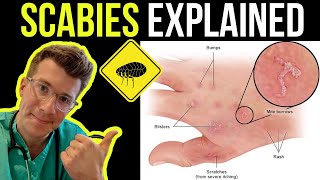 Doctor explains SCABIES skin rash including SYMPTOMS PHOTOS OF SKIN TREATMENT amp more [upl. by Mariejeanne]