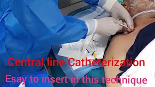 Central line Catheterization without ultrasound guideEasy and simple insert of this technique [upl. by Winn]