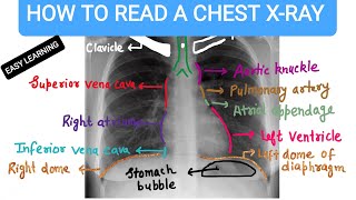 How To Read A Chest Xray [upl. by Leibarg965]