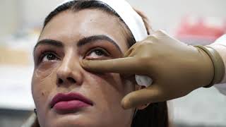 Model Shikha Dogra Gets Safe Under Eye Fillers  Puffy Eyes  AAYNA [upl. by Aizan]