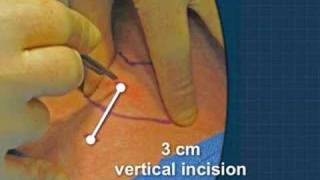 Cricothyrotomy [upl. by Jarred444]