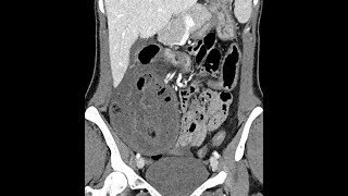 Small bowel ischemia associated with a parastomal hernia postileostomy in a Crohns disease patient [upl. by Marpet945]