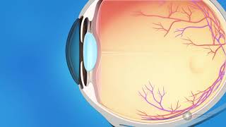 What is glaucoma [upl. by Adohr]