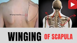 WINGING Of SCAPULACausesTreatmentwinging scapula causes treatment anatomy demage nerve yt [upl. by Keri]