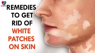 Remedies To Get Rid of White Patches On Skin  Health Sutra [upl. by Reffineg937]