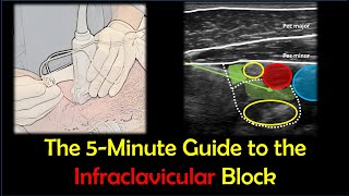 Infraclavicular Brachial Plexus Block  a quotHowToquot Guide [upl. by Ayanaj]