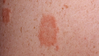 Pityriasis rosé  Pityriasis rosea Galerie photo  Photo gallery [upl. by Warfold894]