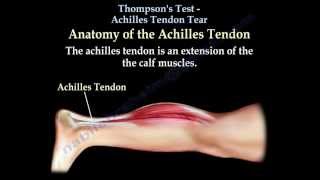 Thompsons Test Achilles Tendon Tear  Everything You Need To Know  Dr Nabil Ebraheim [upl. by Ramos]