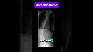 Osteoblastoma [upl. by Othilie]