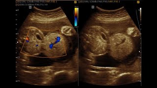 Omphalocele and Bilobed Placenta [upl. by Anitsyrk]