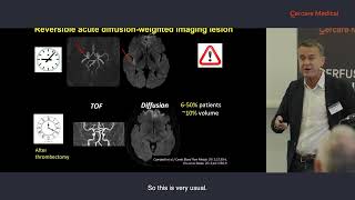 Prof Yves Berthezène Advancements in Stroke MRI Unveiling the Role of Perfusion in 2024 [upl. by Annert]