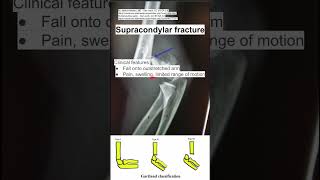 Supracondylar fracture [upl. by Ecnerwal624]