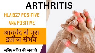 Reverse your Arthritis with Ayurveda Patient testimonial HLAB27 Positive ANA positive [upl. by Yehtomit]