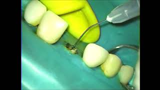 根管治療 Root canal treatment [upl. by Aisetal491]