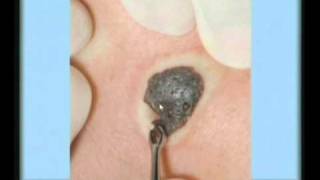 Seborrheic Keratosis Treatment [upl. by Wilmar]