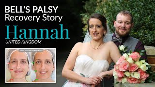 Hannahs Bells palsy and synkinesis recovery story [upl. by Sllew644]