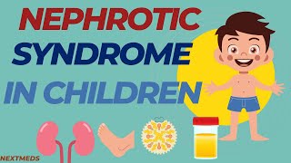 Nephrotic Syndrome In ChildrenCausesSigns And SymptomsDiagnosisTreatmentPaediatrics [upl. by Cumine]