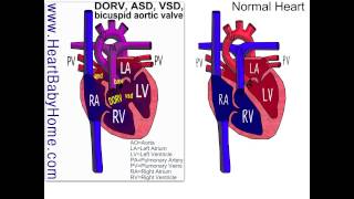 38 Double Outlet Right Ventricle with ASD VSD bicuspid aortic [upl. by Stein26]