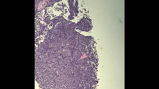 CD5negative small Bcell lymphoma [upl. by Lyj]