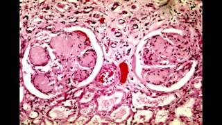 Lab Findings Gout Urate crystals KimmelstielWilson Nodules amp Novobiocin Response  Rapid Review [upl. by Ytsirc]