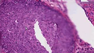 Squamous Metaplasia of Cervix amp Carcinoma in Situ Histopathology Madeformedicalcom [upl. by Haimerej]