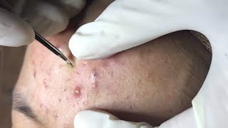 How To Remove Blackheads And Whiteheads On Face Easy 59 ✦ Dr Laelia ✦ [upl. by Aitak]