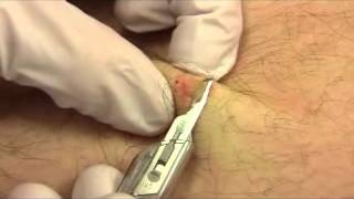 Shave Biopsy [upl. by Eelatsyrc]