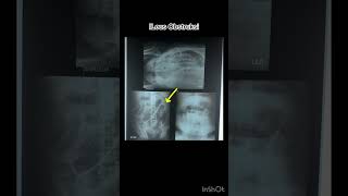 Ileus obstruksi xray radiology pemeriksaankesehatan bhojpuri [upl. by Ranip]