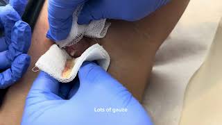 PIMPLE POP ABSCESS IampD [upl. by Fernas]